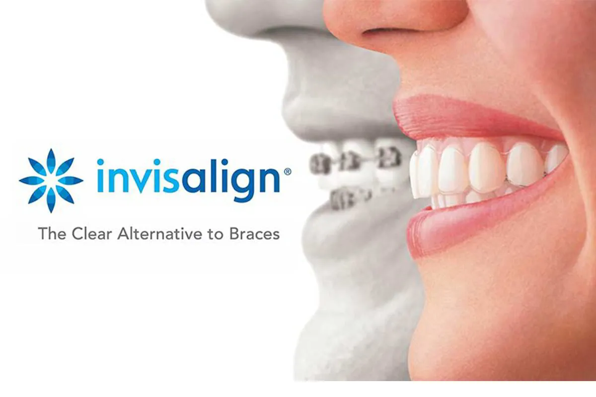 Invisalign clear aligners as an alternative to traditional braces for straighter teeth