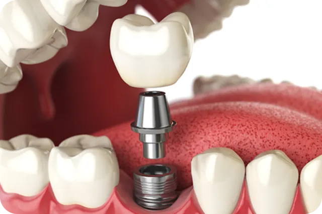 Dental implant treatment for a missing tooth