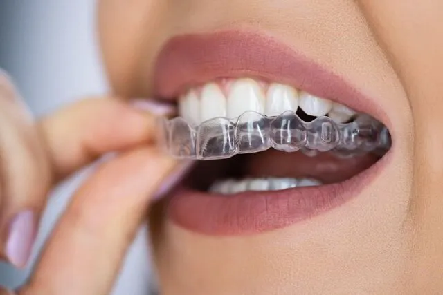 Removable Invisalign clear aligners for teeth straightening