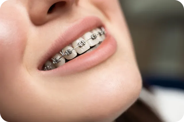 Metal braces for straightening misaligned teeth