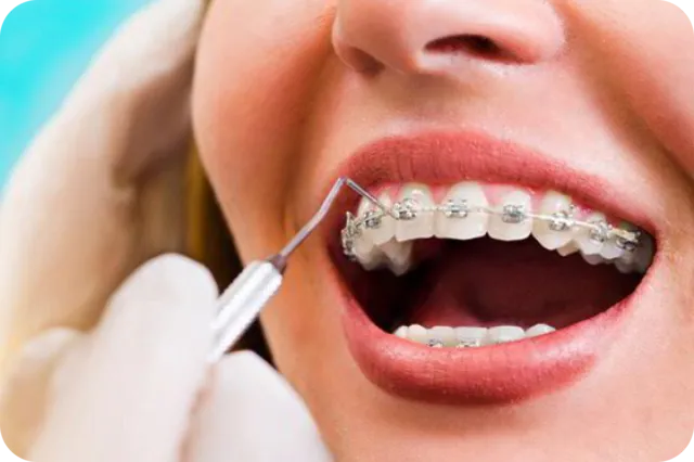 Orthodontic teeth alignment treatment in Bengaluru
