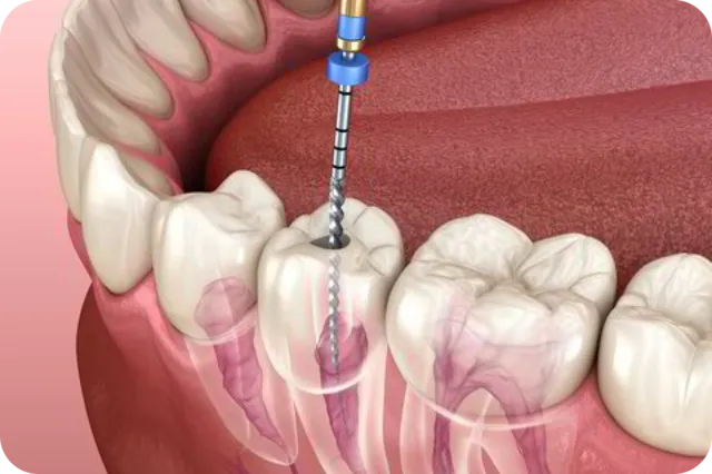 Root canal treatment by an endodontist in RK Hegde Nagar