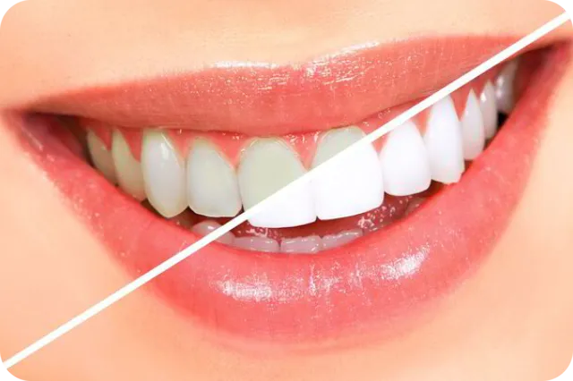 Professional teeth whitening treatment in RK Hegde Nagar