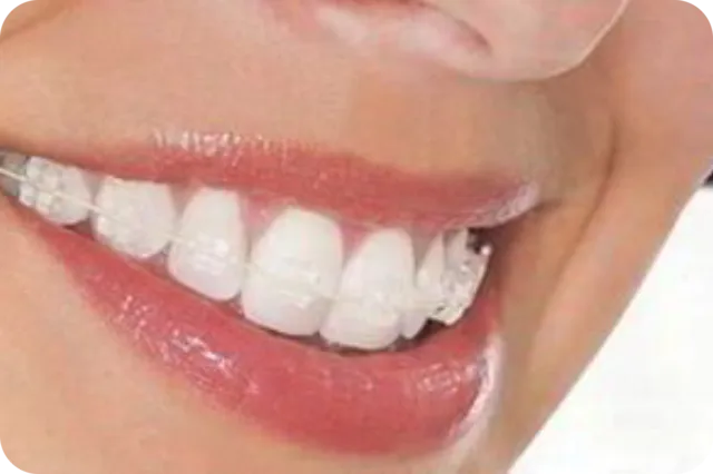 Tooth-coloured ceramic braces for discreet teeth straightening