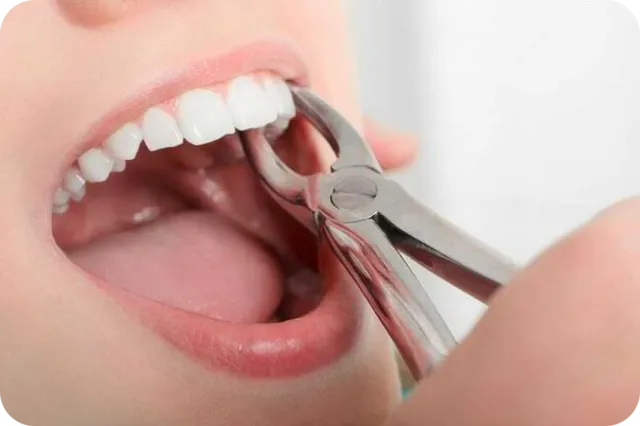 Safe tooth extraction treatment in RK Hegde Nagar