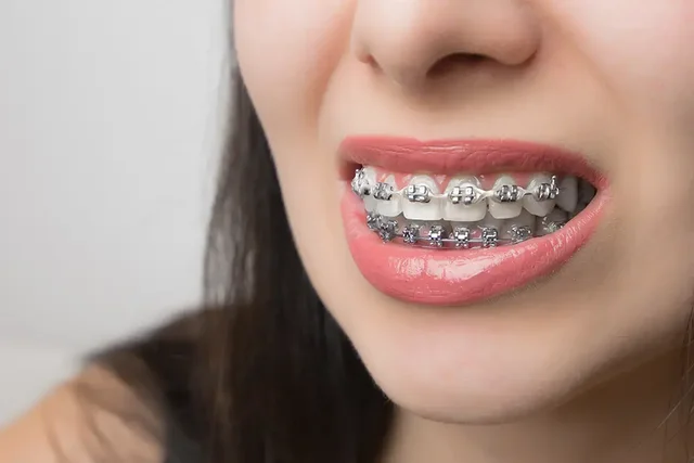 Traditional metal braces attached to teeth